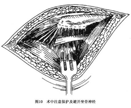 股骨颈骨折