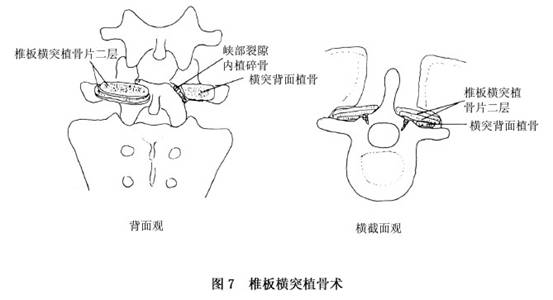 腰部峡部崩裂和脊椎滑脱