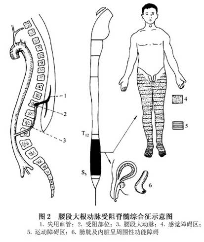 向胸腰段脊髓供血的大根动脉缺血症候群