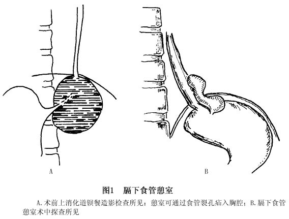 膈下食管憩室