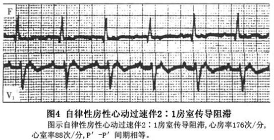 房性心动过速