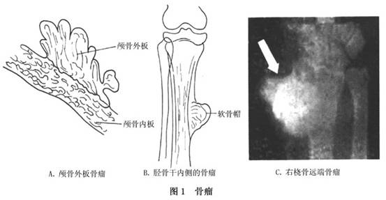 骨瘤