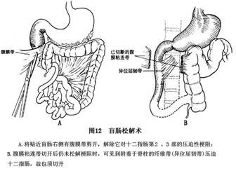 先天性肠旋转不良详情