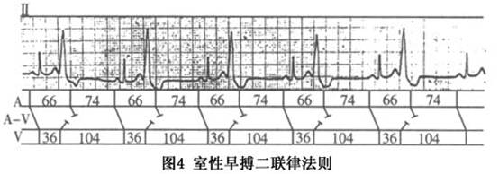 (4)室性期前收缩的反二联律法则(reversed rule of bigeminy):应