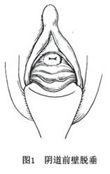 阴道前壁膨出