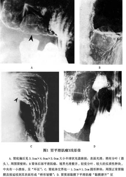 胃平滑肌瘤