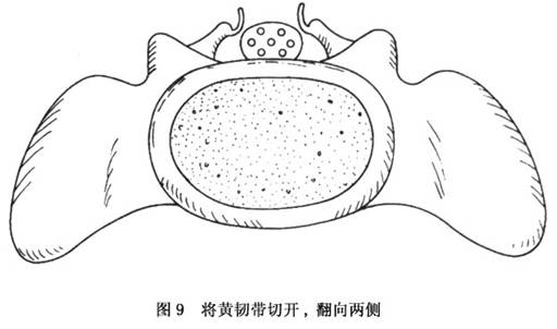 疗效多欠满意,主要是由于浮棘下方达深部的纤维组织多与硬膜囊粘连,此