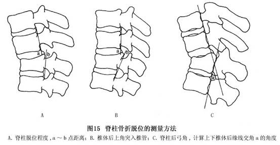 ct检查可见有无椎板骨折下陷,关节突骨折,爆裂骨折骨折块突入