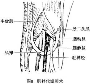 (6)股静脉壁环缝术:对因股静脉扩张而造成的相对性瓣膜关闭不全