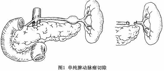 脾动脉瘤