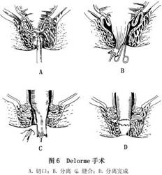 delorme手术(图6 本手术除能完全环行切除直肠内脱垂的黏膜(4～10cm