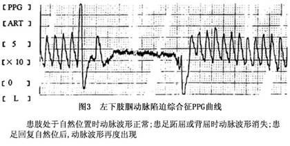 彩色超声检查  可作为本病的首选检测方法,特别是动态测定踝部动脉