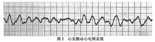 心室颤动心电图特征为qrs波群与t波完全消失,代之以形态不一,大小不等