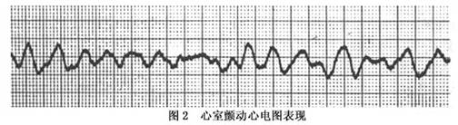 老年人心室扑动与颤动