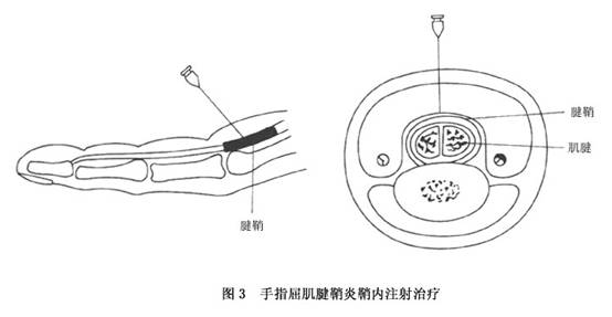 手指屈肌腱鞘炎