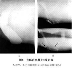 直肠内套叠