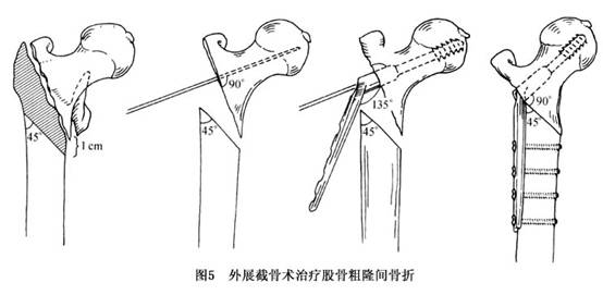 股骨转子间骨折