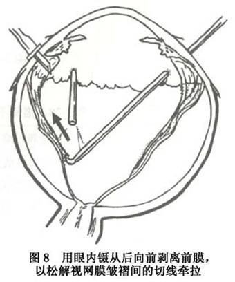 增生性玻璃体视网膜病变