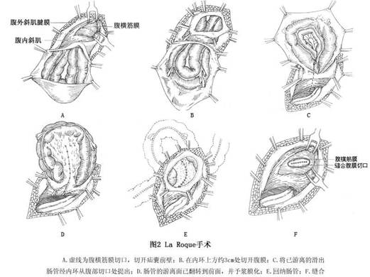 腹股沟滑动疝