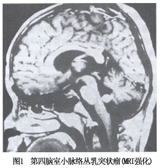 儿童为颅缝分离,15%～20%可见病理性钙化,侧脑室肿瘤钙化较正常脉络丛