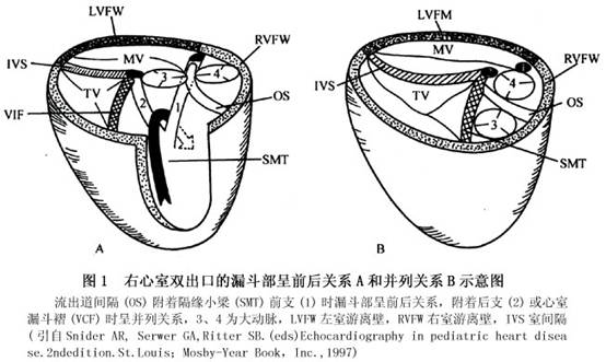 小儿右室双出口