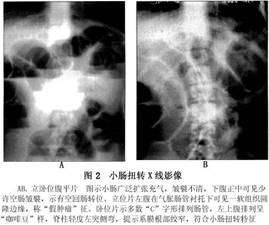 腹部x线平片  可见小肠普遍胀气和多个液平面(图2),有时可见假肿瘤征