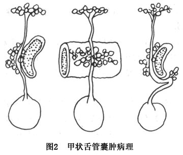 甲状腺舌管囊肿 www.guahao.com