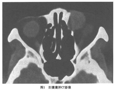 慢性泪囊炎  可分为卡他性泪囊炎,黏液囊肿和慢性化脓性泪囊炎等几种.