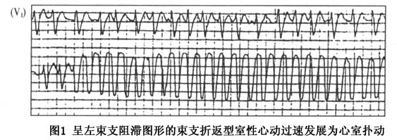 束支折返性室性心动过速