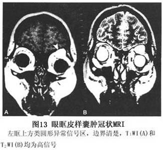 眼眶皮样囊肿