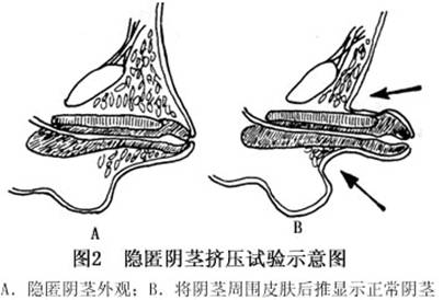 隐匿阴茎
