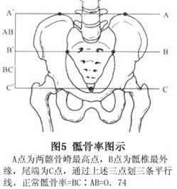 新生儿肛门和直肠畸形