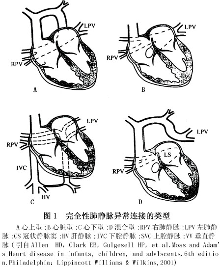 小儿完全性肺静脉异位连接