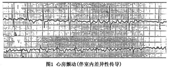 房颤