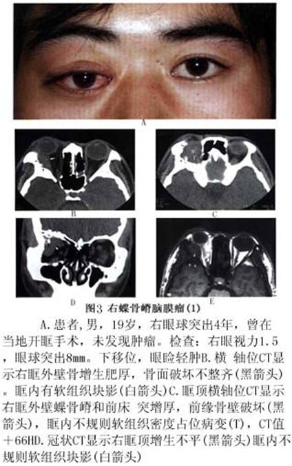 蝶骨脑膜瘤的眼眶病变