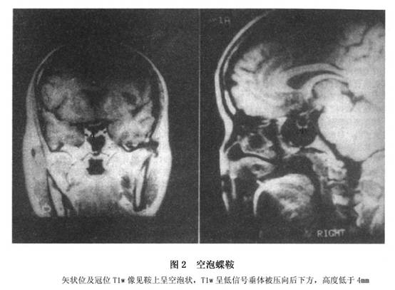 空蝶鞍综合征的mri诊断与临床分析