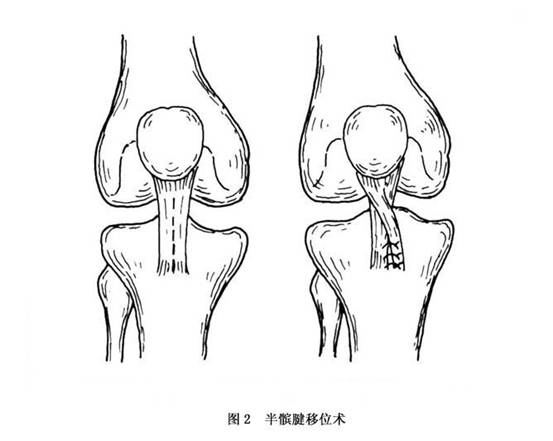 缝合滑膜,将髌腱向下向内移位,使髌骨位于股骨髁间的正常位置,并使伸