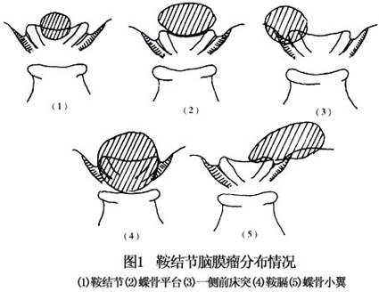 鞍结节脑膜瘤