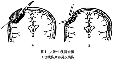 但硬脑膜尚完整,创伤局部与对冲部位可能有脑挫裂伤,或形成