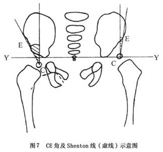 先天性髋关节脱位