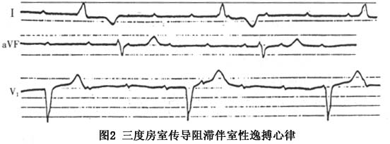 室性逸搏及室性逸搏心律