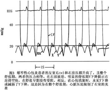 qrs波低电压,t波平坦或倒置,两者同时存在是诊断缩窄性心包炎的强力