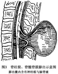 脊膜膨出与脊膜脊髓膨出