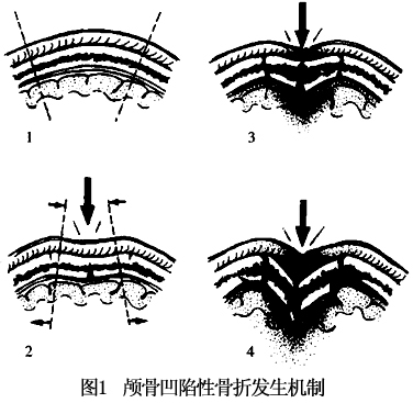 向前伸至颅前窝,向后可达枕骨,严重时甚至引起矢状缝分离性骨折