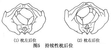 持续性枕后位难产