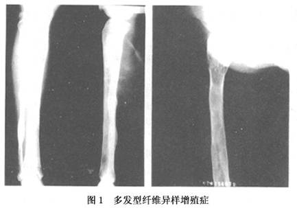 骨纤维结构不良