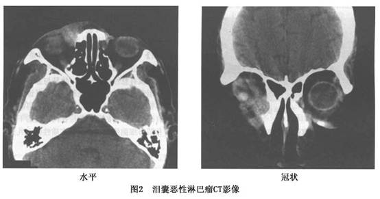 影像学检查  包括超声检查,ct和mri等可帮助诊断,ct扫描可显示泪囊区