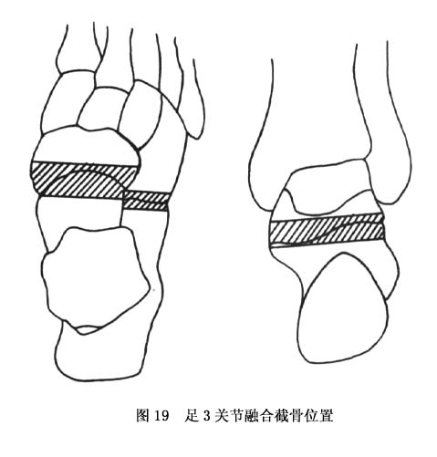 ⑤跟骨截骨术:由于跟骨横形压缩骨折,早期未予复位,bohler角及足