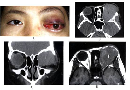 眼眶非霍奇金恶性淋巴瘤