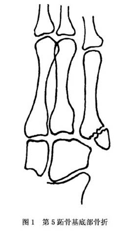 跖骨骨折